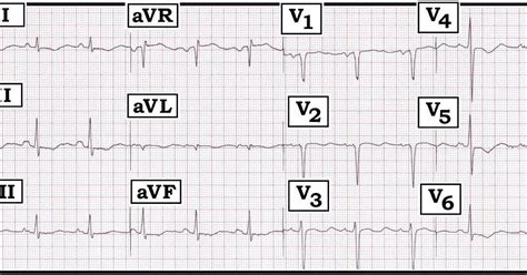 ECG Interpretation: ECG Interpretation Review #27 (ST-T Wave Changes ...