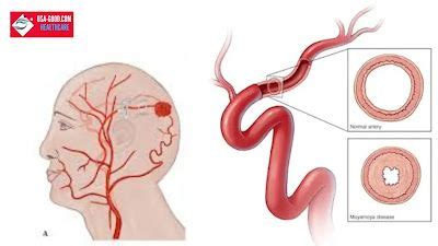 Moyamoya disease causes symptoms diagnosis treatment – Artofit