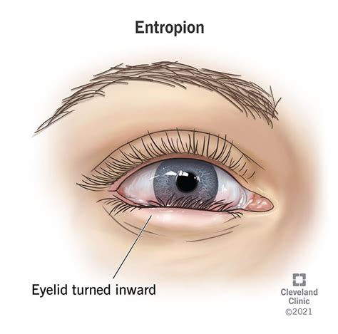 Entropion: Types, Definition, Surgery & Treatment