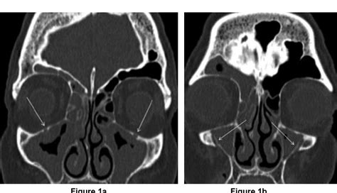 Figure 1 from Evaluation of infraorbital canal anatomy and related ...