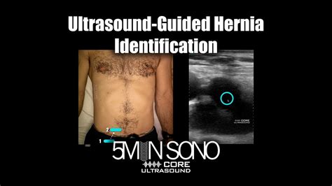 Ultrasound-Guided Hernia Identification - YouTube