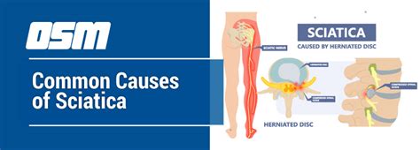 Common Causes of Sciatica - Orthopedic & Sports Medicine