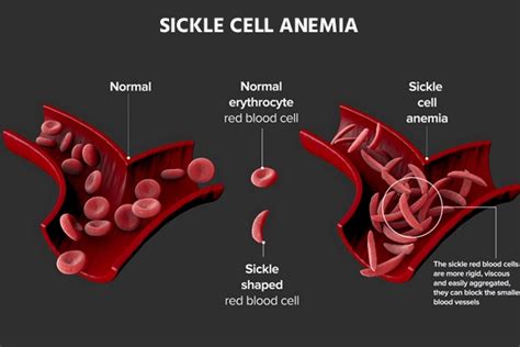 Sickle cell anemia: Causes, Symptoms & Treatment