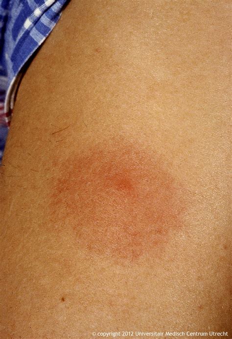 The characteristic bullseye rash for Lyme disease | Innatoss