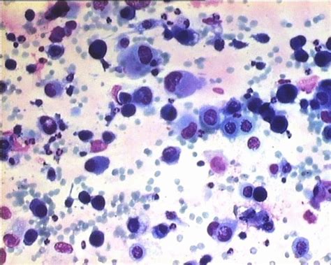 Mucoepidermoid carcinoma (PAP stain, magnification ×400) initially ...