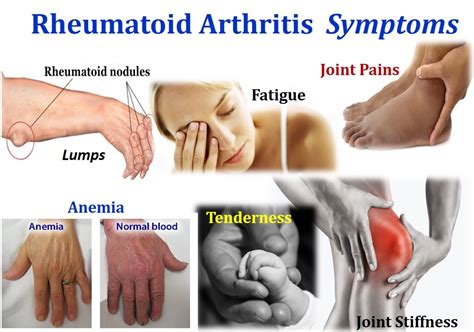 Arthritis Symptoms