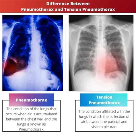 Closed Pneumothorax Vs Tension Pneumothorax - Penelope Quinn