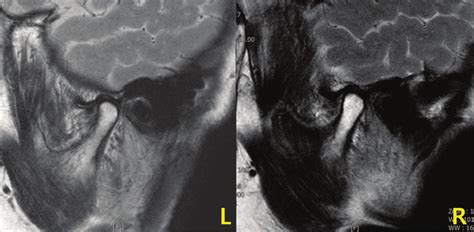 Temporomandibular joint (TMJ) magnetic resonance imaging (MRI). MRI ...