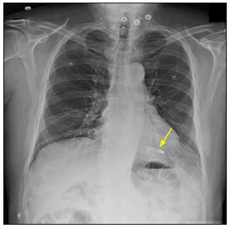 PSA for MRI techs. To me, this Medtronic Micra pacemaker looks like a ...