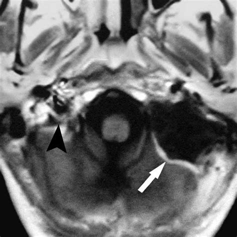 (a) Coronal T2-weighted MRI, showing the jugular foramen (arrow head ...