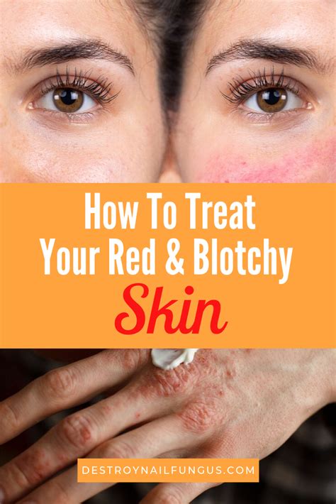 Simple Remedies to Treat Your Blotchy Skin