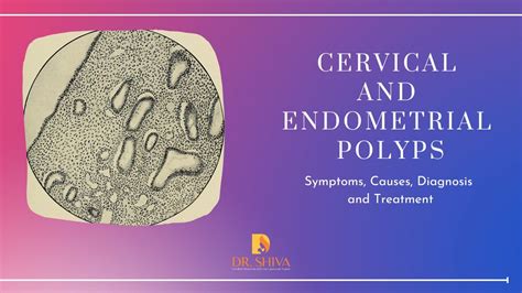 Cervical and Endometrial polyp | Cause and Treatment