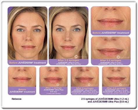 Juvéderm™ & Fillers | Houston Medical Wellness Clinic