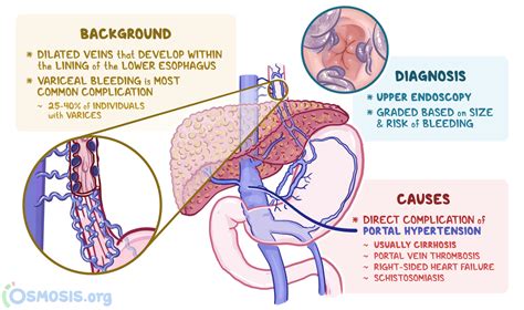 Esophageal Varices: What Are They, Causes | Osmosis