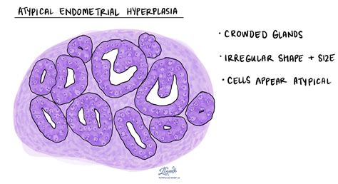 Endometrial Hyperplasia Histology