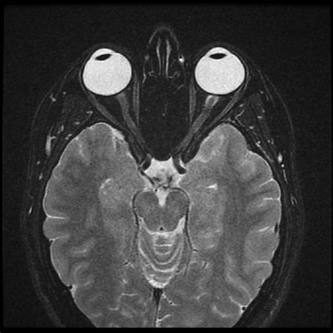 Optic Neuritis | Geeky Medics