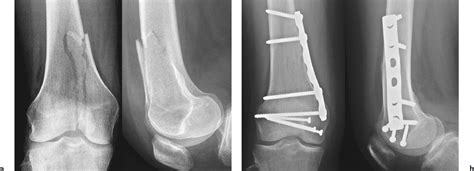 Femur Bone Fracture Surgery