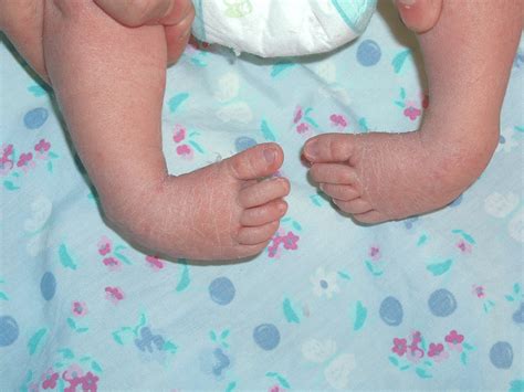 Congenital Talipes Equinovarus (Clubfoot) Nursing Care Management ...