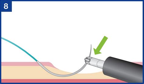 Basic operation and techniques for Endoscopic Hand-Suturing with ...