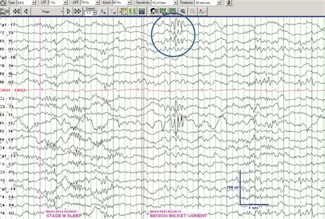 Abnormal eeg results - naxrewall