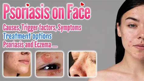 Psoriasis on Face Causes, Symptoms, Trigger Factors, Types ...