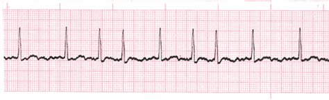 Atrial Fibrillation - EKG Lesson #312