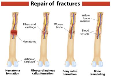 Explain the Difference Between a Fracture and a Broken Bone - Case-has ...