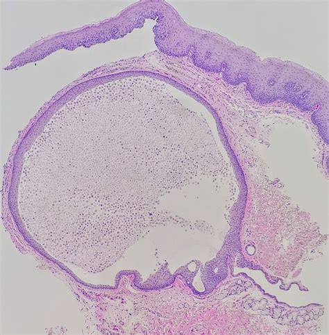 Mucocele Histology