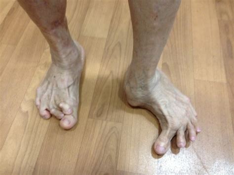 Foot Deformities Singapore|Surgery Reconstruction|Correction