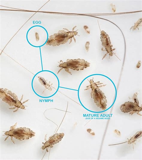 Louse, Nits & Head Lice Eggs. What Are They?