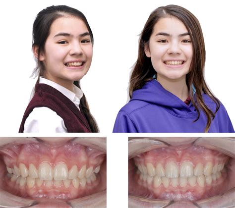 Before-and-After Braces & Invisalign | Matsumoto Orthodontics ...