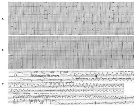 Figure. Electrocardiograms with normal and prolonged QTc. | Download ...