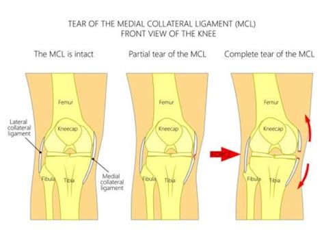 MCL Injury | Signs, Symptoms, Treatment & Prevention