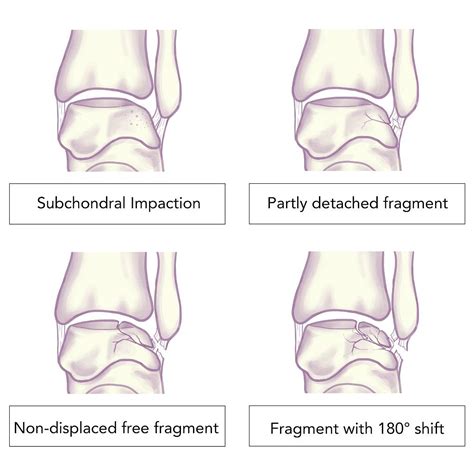 Talar Dome Injury Management For Foot | East Coast Podiatry