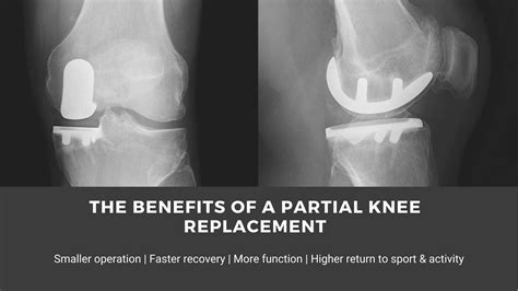 Partial Knee Replacement | Faster Recovery