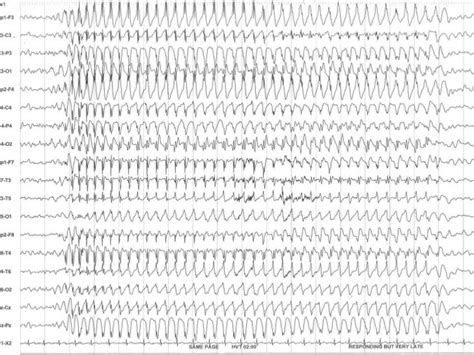 Abnormal EEG patterns