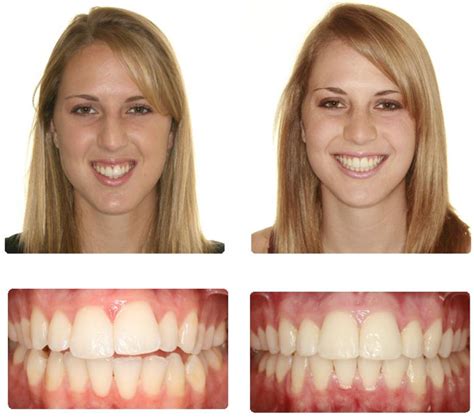 before-after-brace - G1 Dental Practice | NHS Dentist Glasgow City ...