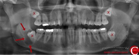 Oral and Maxillofacial Surgery - Removal of Impacted Wisdom Teeth ...