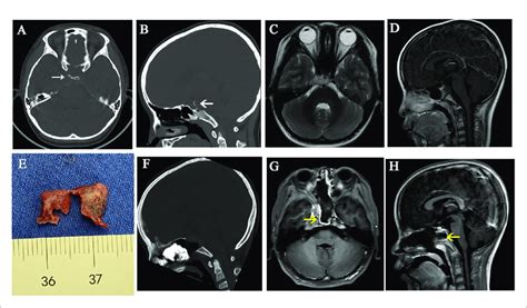 | A case illustrates dorsum sellae and posterior clinoid process ...