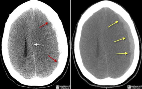 Learning Radiology - subdural, hematoma