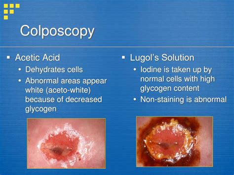 PPT - Management of Abnormal Pap Smears and Cervical Dysplasia ...