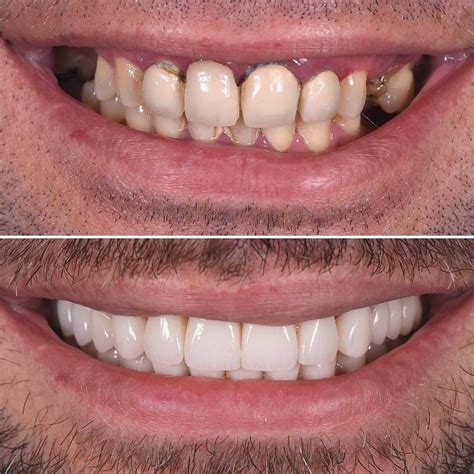 What is the difference between composite veneers and porcelain veneers ...