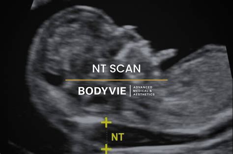 12 Week Ultrasound Down Syndrome