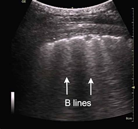 Cureus | Application of Lung Ultrasound in Critical Care Setting: A Review