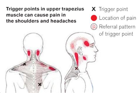 Swollen Trapezius Muscle