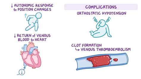 Preventing Complications of Immobility - Osmosis Video Library