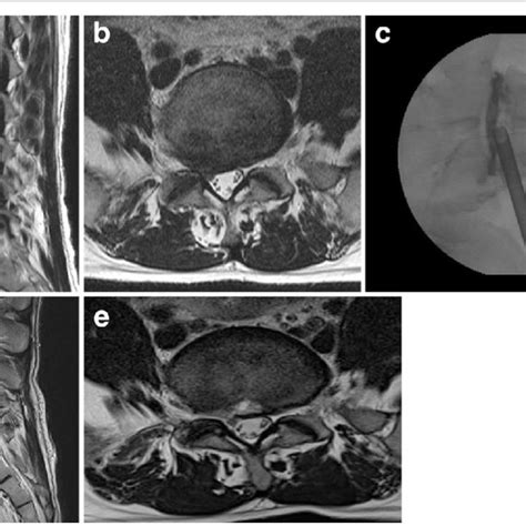 Four years later, MR images showing disc extrusion at the L5-S1 (a and ...