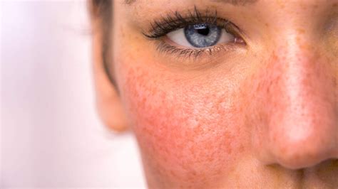 Itch or Non-Itchy Red Face Rash Causes and Treatments - American Celiac