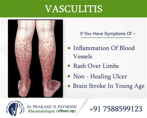 Vasculitis - Dr.PrakashPaymode