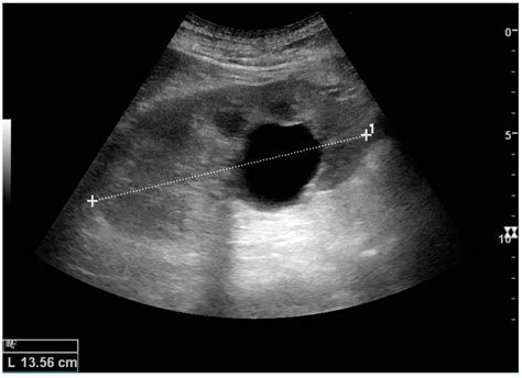 Kidney Ultrasound